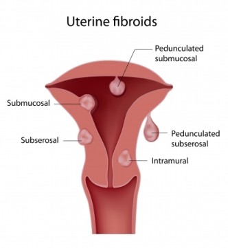 Various Types of Uterine Fibroids